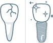 Implantat Icon